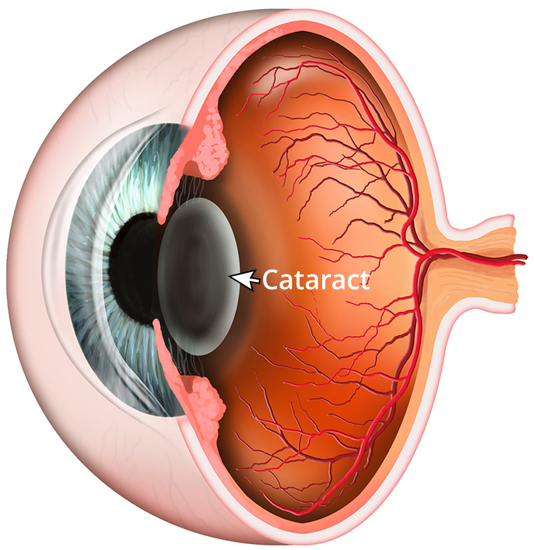 Cataract explanation