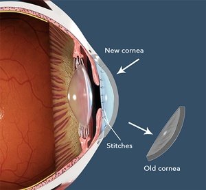 Cornea treatment