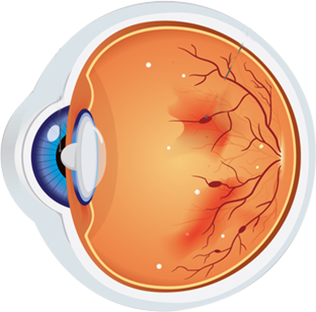 Diabetic retinopathy explanation