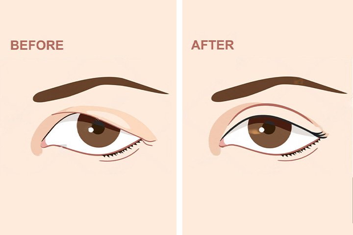 Oculoplasty explanation